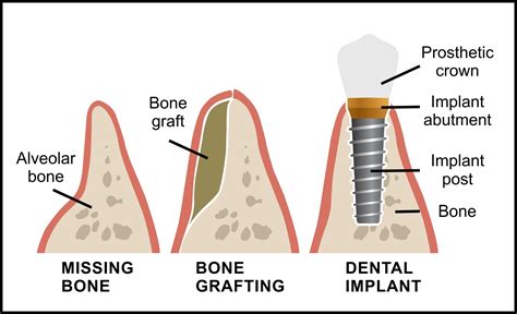 Best Bone graft for dental implants .
